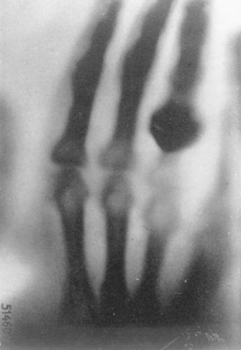 hasil rontgen Anna Bertha Ludwig